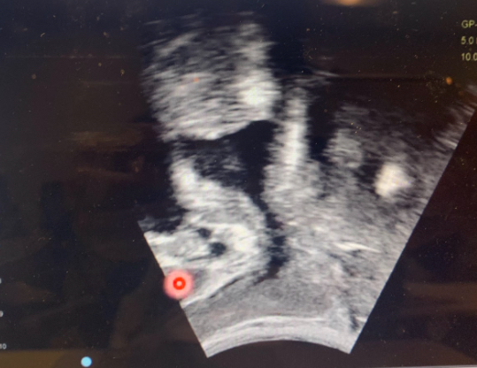 Real-time ultrasound imaging showing pelvic floor muscles